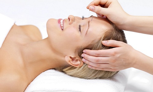 acupuncture1